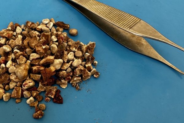 Tıp Dünyasını Şoke Eden Vaka: İki Böbreğinden 300’ün Üzerinde Taş Çıkarıldı